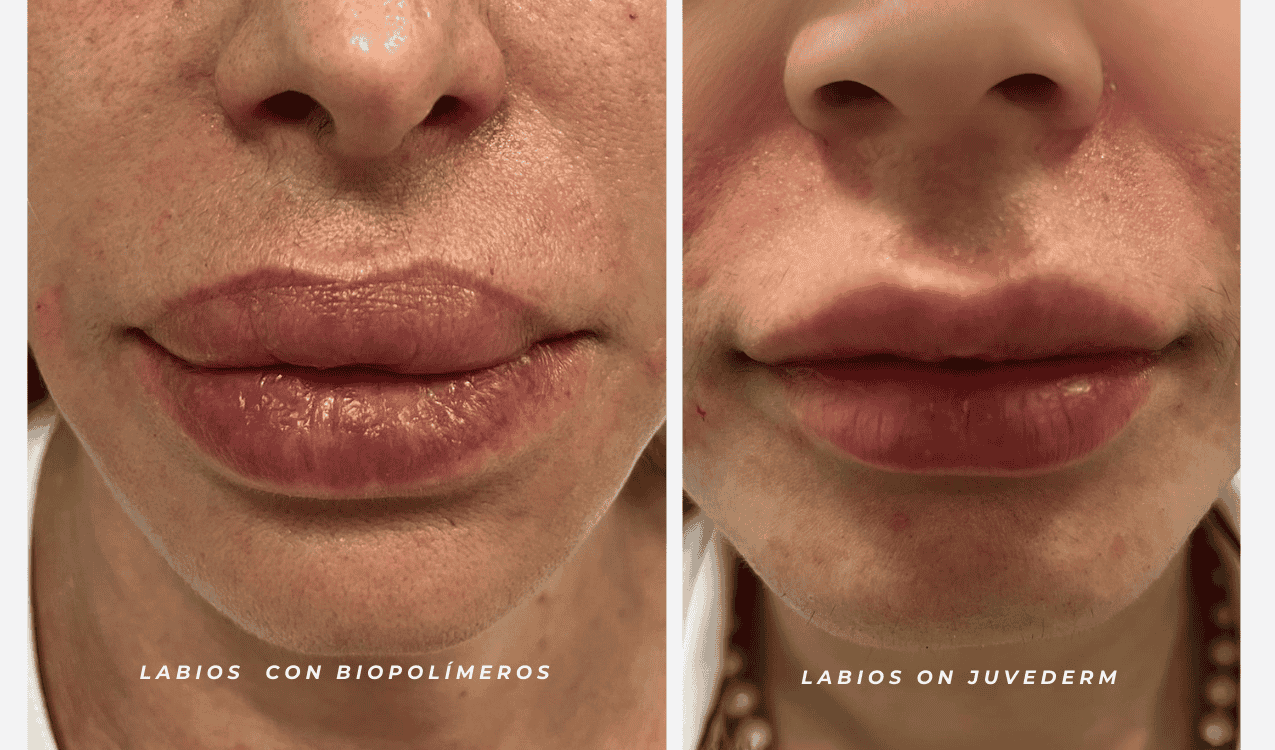 Perfect Lips: Juvederm vs. Biopolymers